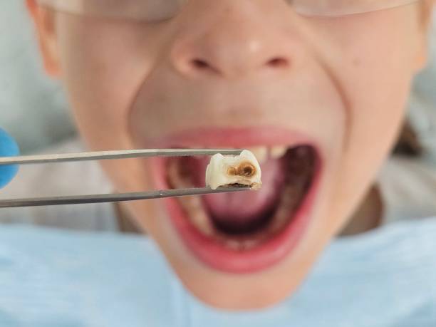 Best Emergency Wisdom Teeth Removal in Wake Forest, NC